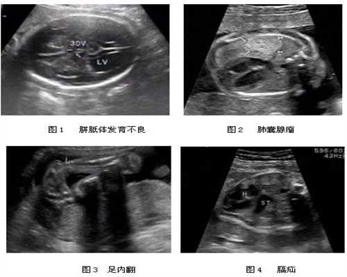 广州哪家助孕中心好：生双胞胎的明星家庭，谢