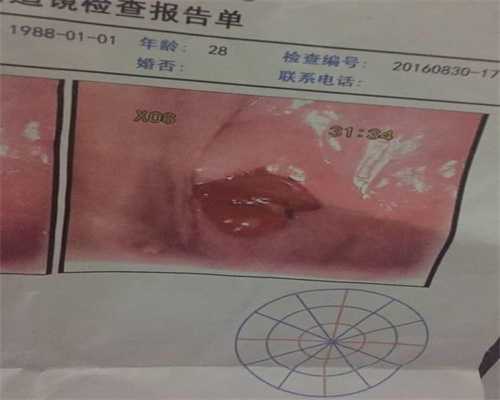 中国首例卵巢组织冷冻移植宝宝诞生