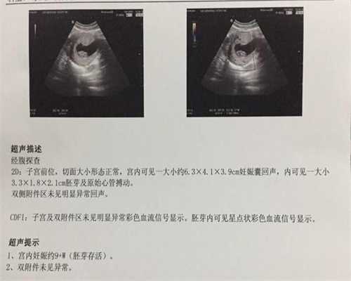 广州试管助孕包成功	：高鹰代孕妈妈分娩前即使再紧
